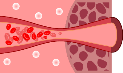 손상으로 인해 조직 산소 공급이 제한된 혈관