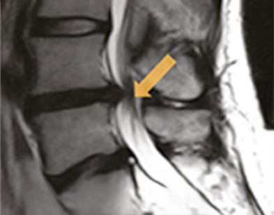 치료 전 MRI